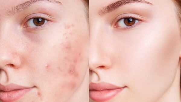 ژل شستشو سراوی حاوی 2% سالیسیلیک اسید | ضد جوش و درمان آکنه و جوش سر سیاه - Image 6