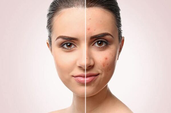 ژل شستشو سراوی حاوی 2% سالیسیلیک اسید | ضد جوش و درمان آکنه و جوش سر سیاه - Image 7
