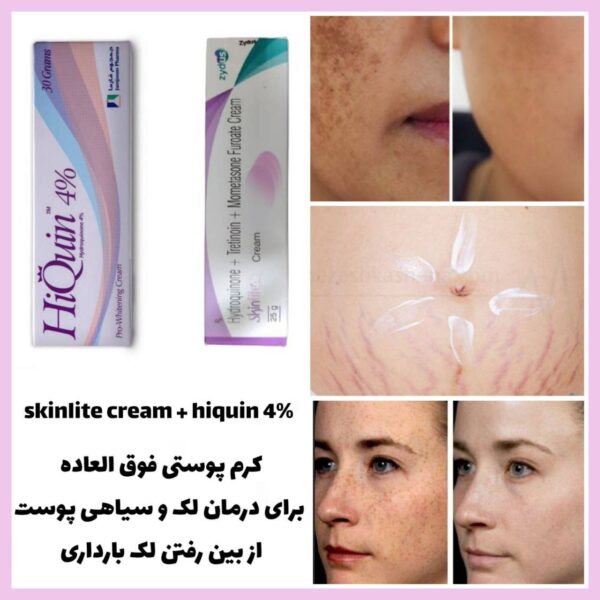 کرم رفع لک و تیرگی صورت و بدن | لک های بارداری، آفتاب سوختگی و جوش - Image 3