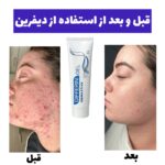 ژل ضدجوش و لایه بردار قوی دیفرین - Image 3