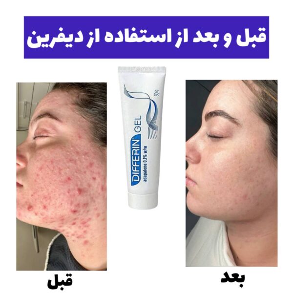 ژل ضدجوش و لایه بردار قوی دیفرین - Image 3